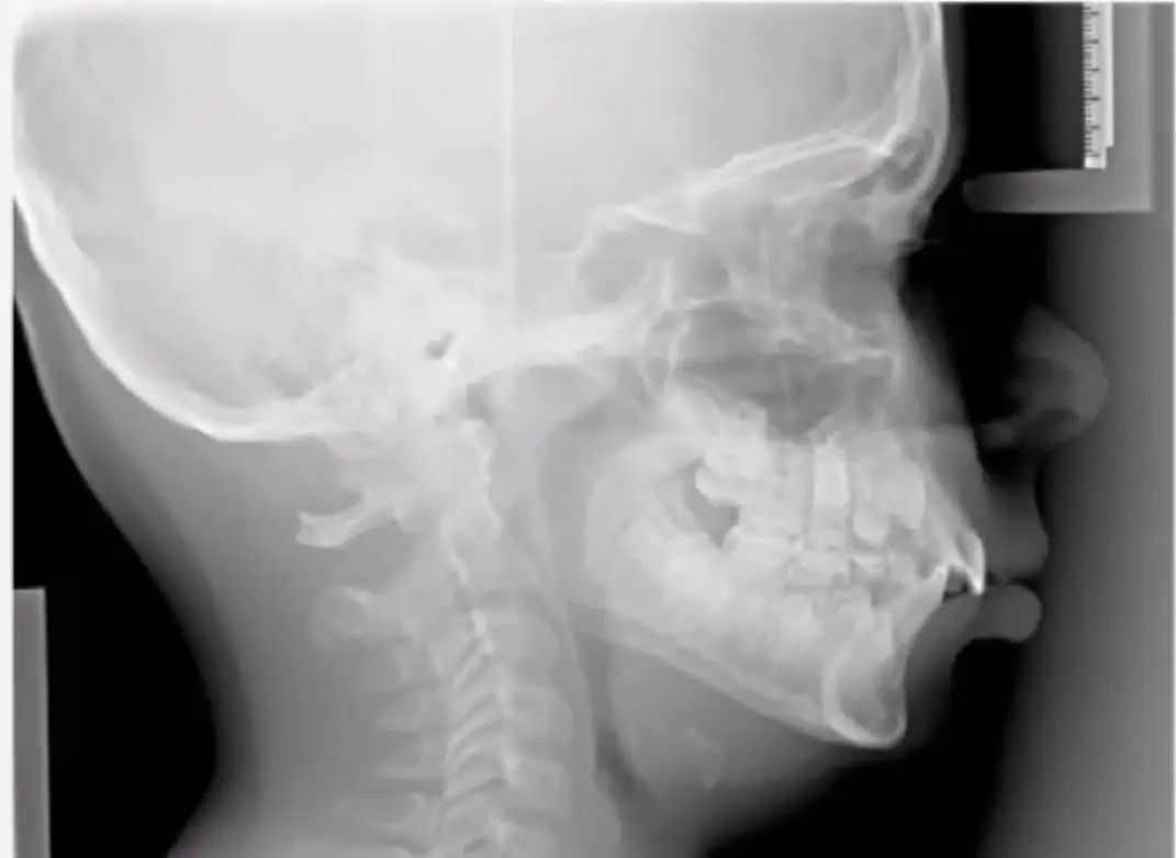 An x-ray image of a child with an underdeveloped airway.