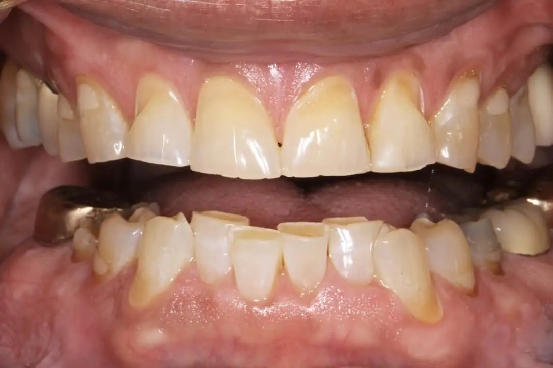 A close-up image of a patient’s worn down, discolored teeth