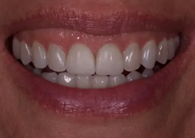 A close-up image of worn, discolored teeth