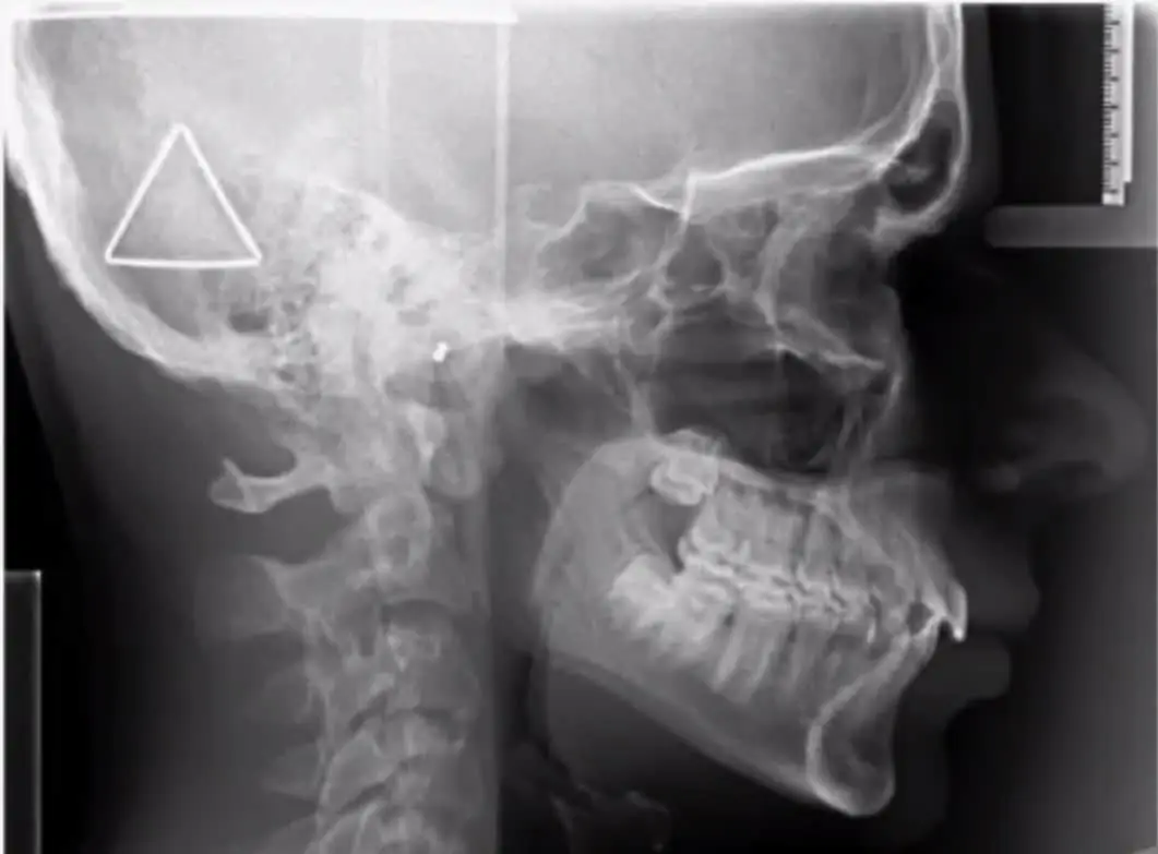 An x-ray image of a child with a healthy, functional airway.