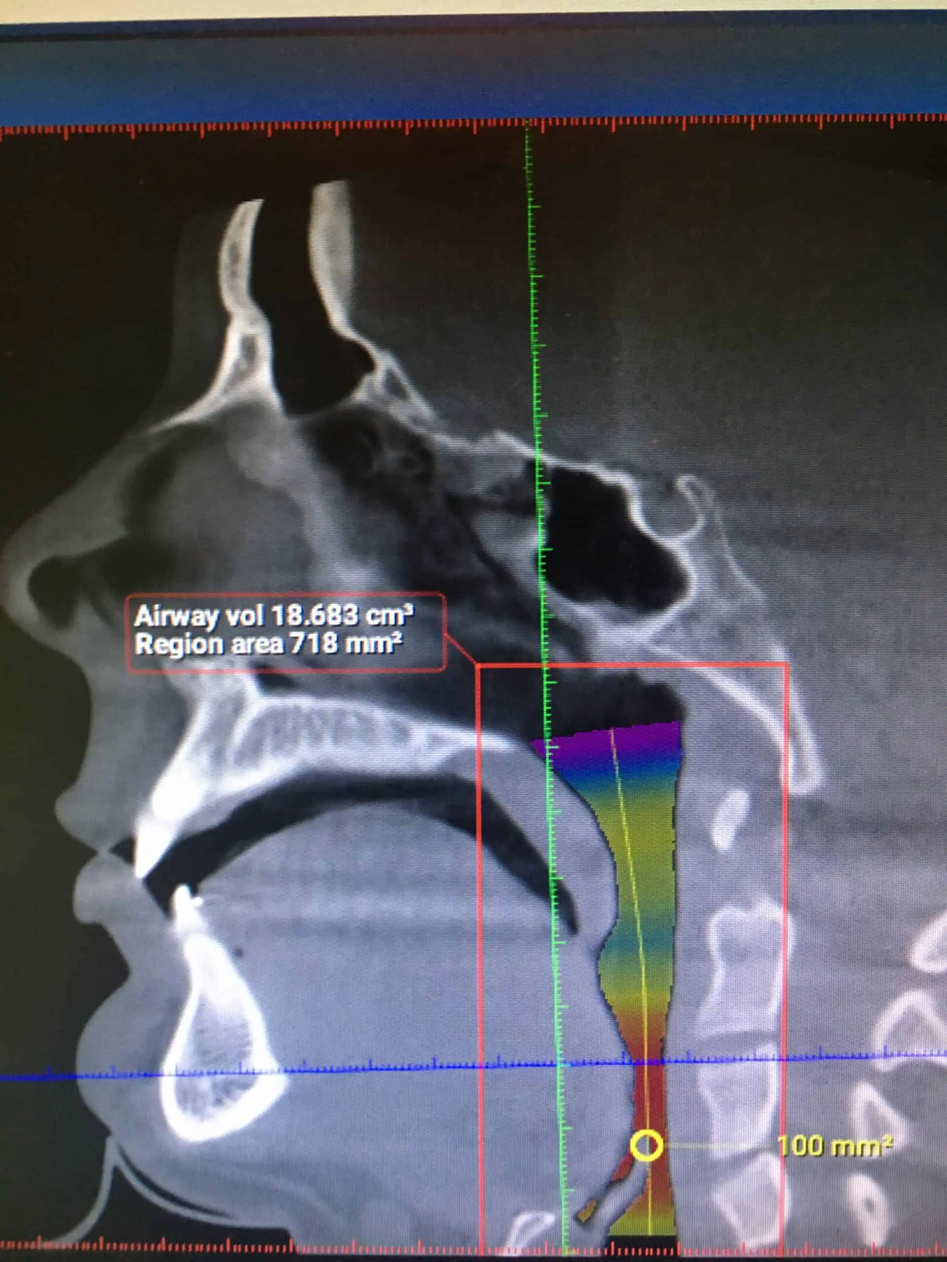 A still image of a 3D sleep airway scan.