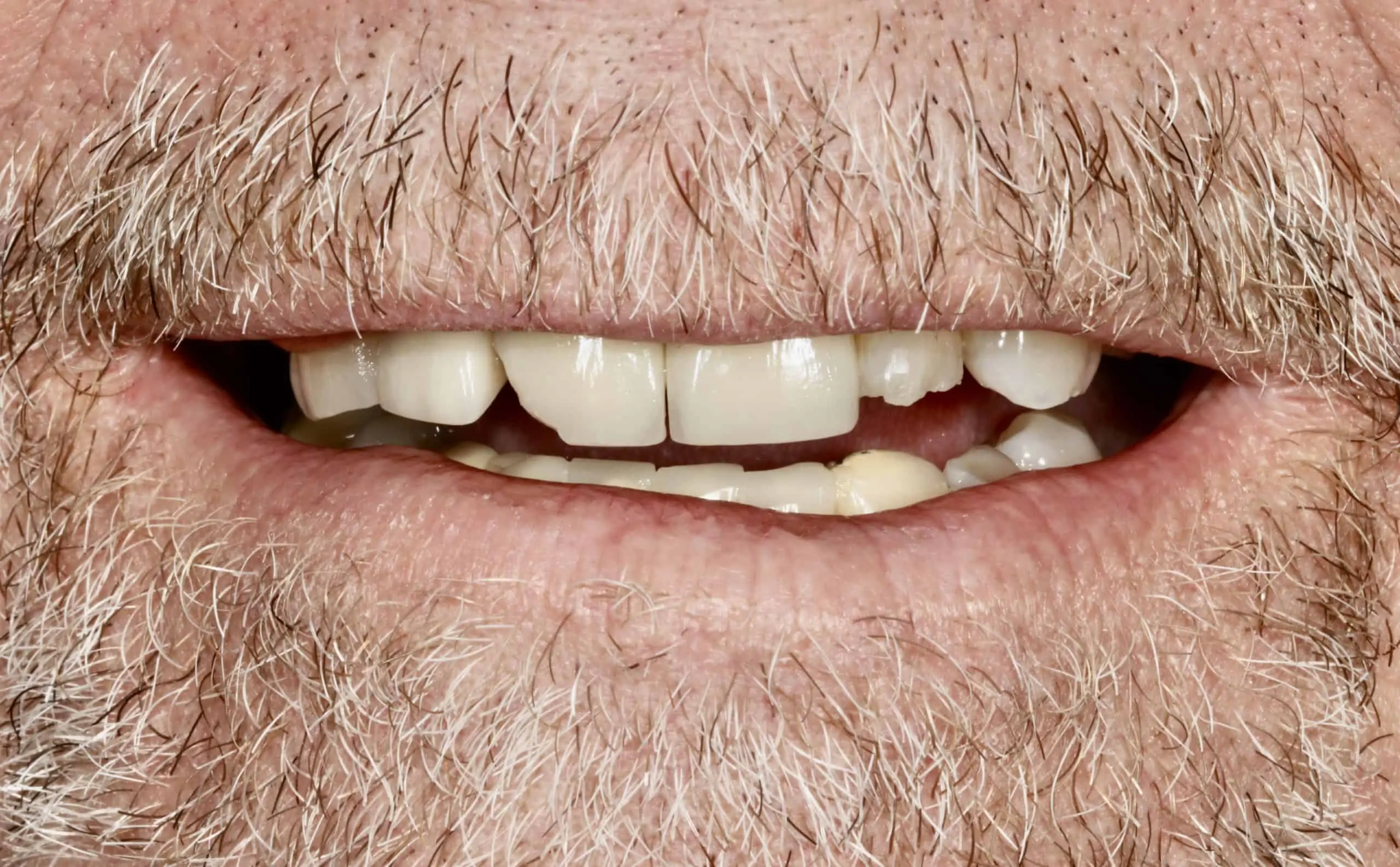 A close-up photo of a patient’s crooked, broken teeth.