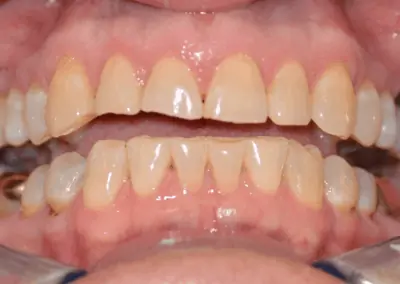 A close-up image of worn, discolored teeth