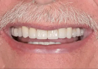 Patient smiling with straight, even, white teeth after receiving treatment at Signature Dentistry of Arvada