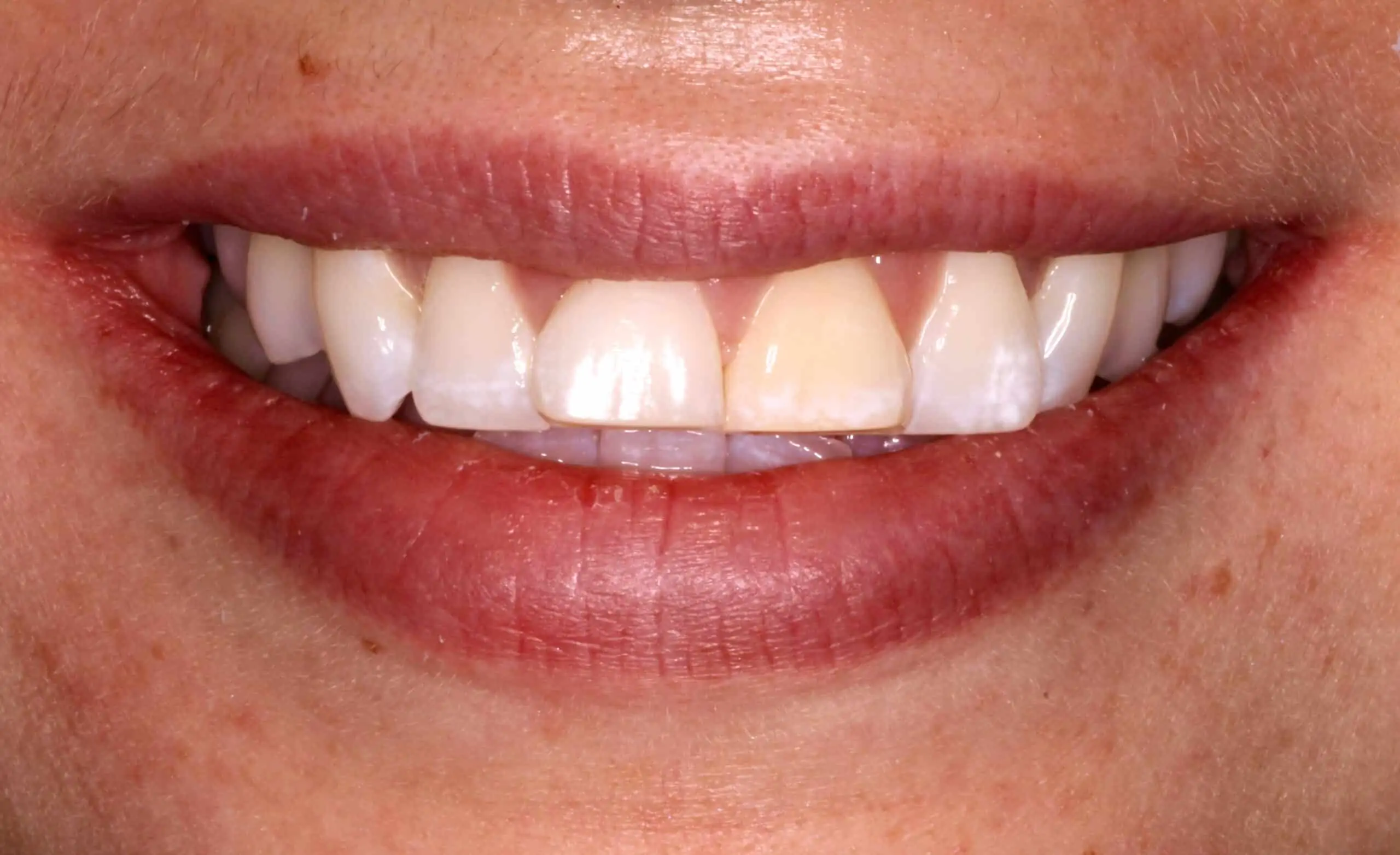 A close-up image of a patient’s uneven, crowded teeth