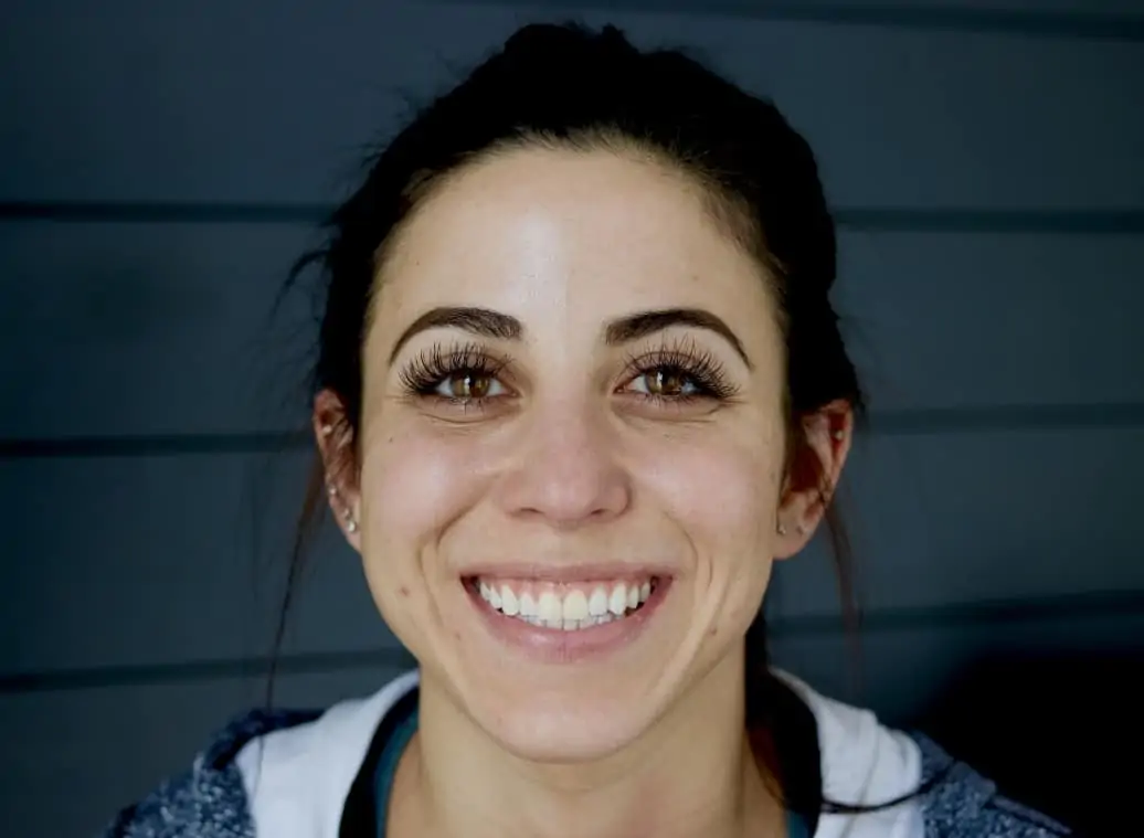 A patient smiling with uneven, discolored front teeth