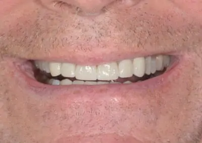 Patient smiling with straight, even, white teeth after receiving treatment at Signature Dentistry of Arvada