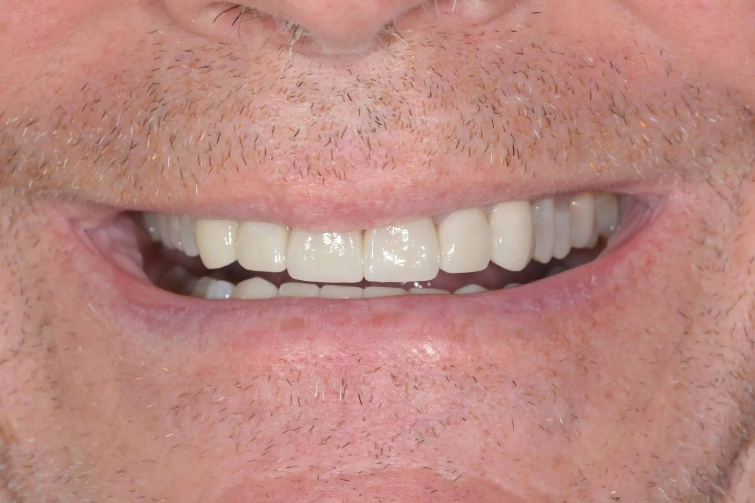 Patient smiling with straight, even, white teeth after receiving treatment at Signature Dentistry of Arvada