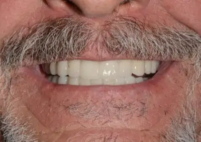 An image of a patient smiling after having received treatment