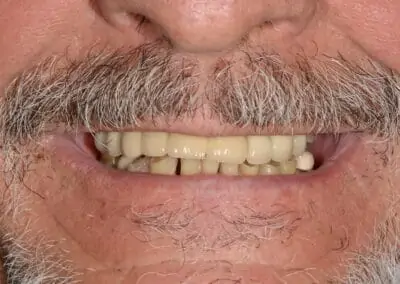 A close-up image of worn, discolored teeth