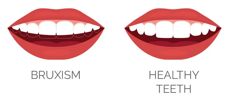 A comparison of short teeth as a result of teeth grinding vs healthy teeth