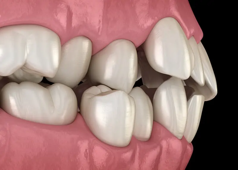 An illustration of human gums and teeth anatomy demonstrating abnormal position of teeth, also known as malocclusion